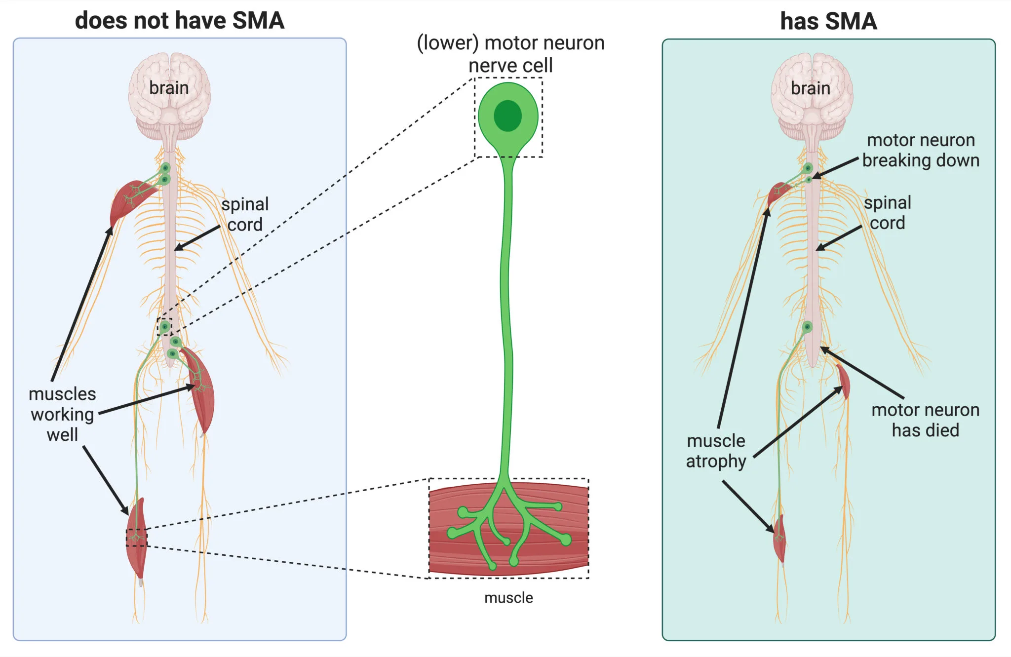 Diagram showing the difference how SMA impacts individuals